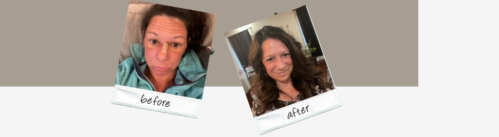 A PERSONAL JOURNEY: MY RECOVERY AND DISCOVERY WITH PDRN