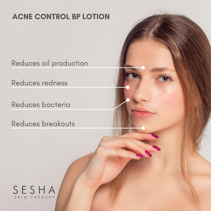 Acne Control BP Lotion